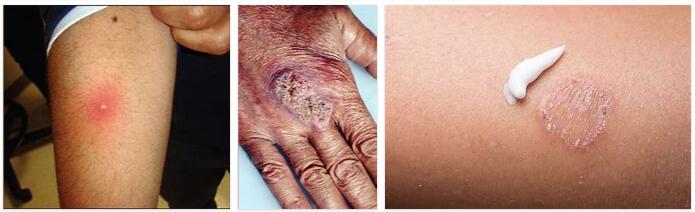 All You Need to Know About Skin Infection
